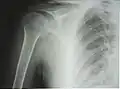 Рентгенограмма верхней части плечевой кости с выраженной хирургической шейкой