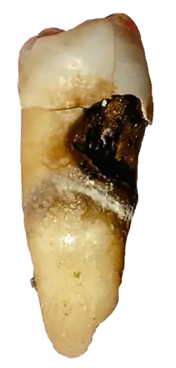 Зуб, поражённый кариесом