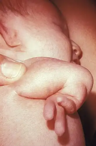 Новорождённый с правосторонней гипоплазией лучевой кости в рамках ассоциации VACTERL